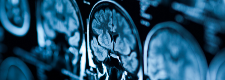 Blog of Reversing Cognitive Decline: Why the Vascular System Holds the Key which have image Reversing Cognitive Decline: Why the Vascular System Holds the Key